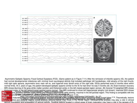 Patients with IS caused by FCD frequently develop partial seizures that can precede, be simultaneous with, or follow the cluster of epileptic spasms. Spasms.