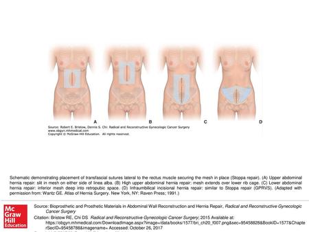 Schematic demonstrating placement of transfascial sutures lateral to the rectus muscle securing the mesh in place (Stoppa repair). (A) Upper abdominal.