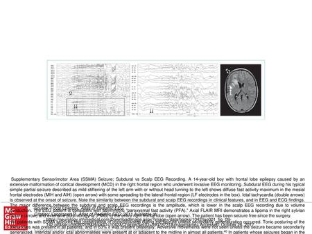 PFA may be a reflection of proximity of the epileptogenic zone to the recording electrodes. Seizures arising from the lateral frontal convexity began with.