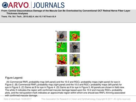 From: Central Glaucomatous Damage of the Macula Can Be Overlooked by Conventional OCT Retinal Nerve Fiber Layer Thickness Analyses Trans. Vis. Sci. Tech..