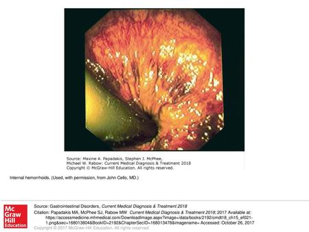 Internal hemorrhoids. (Used, with permission, from John Cello, MD.)