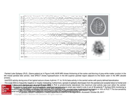 The scalp EEG is frequently negative or maybe misleading; furthermore, spread of epileptic discharges from the parietal and occipital lobes to frontal.