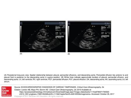 (A) Parasternal long-axis view