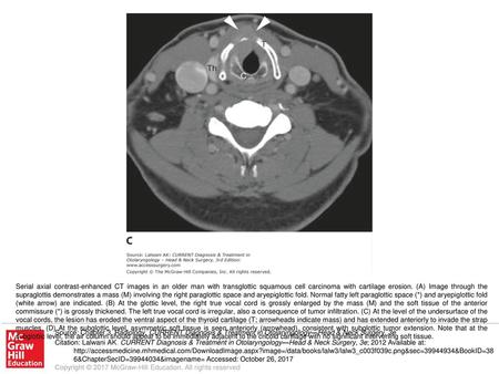 Serial axial contrast-enhanced CT images in an older man with transglottic squamous cell carcinoma with cartilage erosion. (A) Image through the supraglottis.