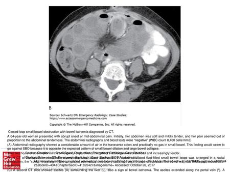 The gasless mid-abdomen on this radiograph (A) may represent a pseudo-tumor sign (fluid-filled loops of dilated bowel), although this finding would be.