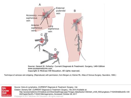 Technique of varicose vein stripping