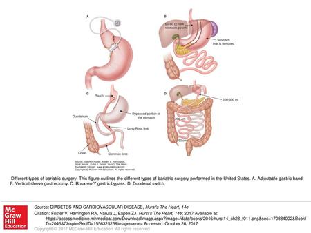 Different types of bariatric surgery