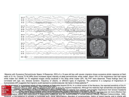 The “H-response” is a prominent photic driving response at flash rates beyond 20 Hz. In a critical review of the literature, the reported sensitivity of.