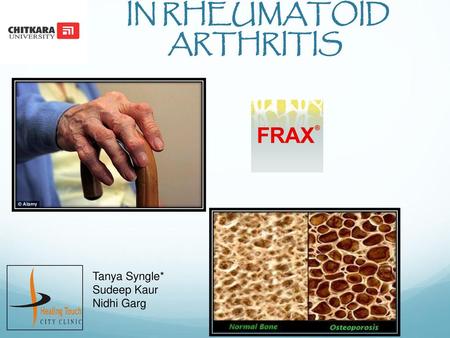 FRAX & ITS ASSOCIATIONS IN RHEUMATOID ARTHRITIS