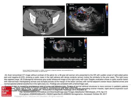 Ovarian torsion is caused by spontaneous twist of ovary and fallopian tube. Torsion of normal adnexal structures is more common in pediatric patients than.