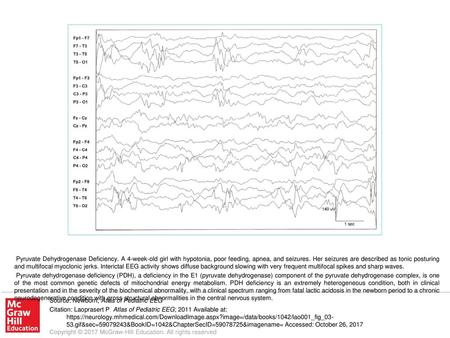 Pyruvate dehydrogenase deficiency (PDH), a deficiency in the E1 (pyruvate dehydrogenase) component of the pyruvate dehydrogenase complex, is one of the.