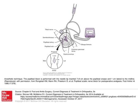 Anesthetic technique. The popliteal block is performed with the needle tip inserted 7–8 cm above the popliteal crease and 1 cm lateral to the midline.