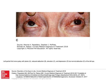 Left partial third nerve palsy with ptosis (A), reduced adduction (B), elevation (C), and depression (D) but normal abduction (E) of the left eye. Source: