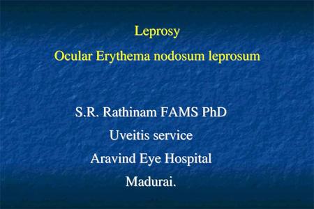 Leprosy Ocular Erythema nodosum leprosum