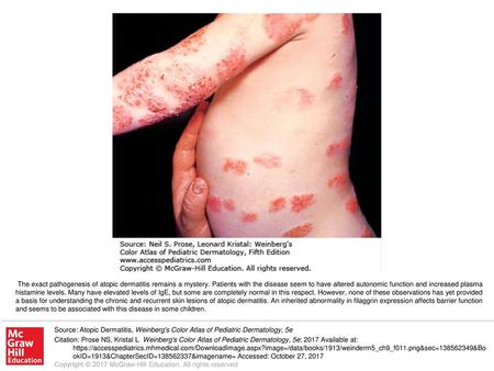 The exact pathogenesis of atopic dermatitis remains a mystery