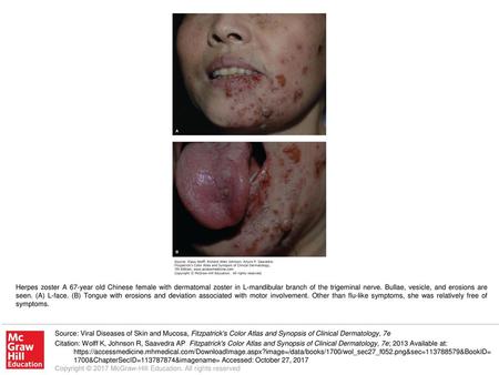 Herpes zoster A 67-year old Chinese female with dermatomal zoster in L-mandibular branch of the trigeminal nerve. Bullae, vesicle, and erosions are seen.