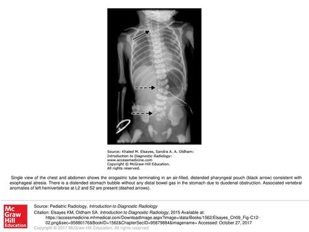 Single view of the chest and abdomen shows the orogastric tube terminating in an air-filled, distended pharyngeal pouch (black arrow) consistent with esophageal.