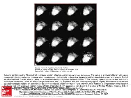 Ischemic cardiomyopathy