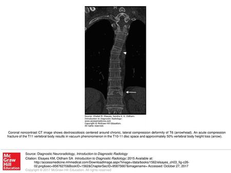 Coronal noncontrast CT image shows dextroscoliosis centered around chronic, lateral compression deformity of T6 (arrowhead). An acute compression fracture.