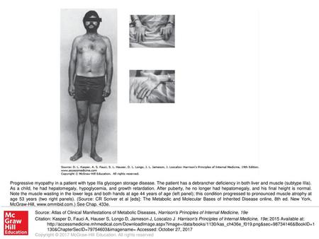 Progressive myopathy in a patient with type IIIa glycogen storage disease. The patient has a debrancher deficiency in both liver and muscle (subtype IIIa).