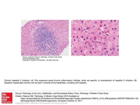 Chronic hepatitis C infection