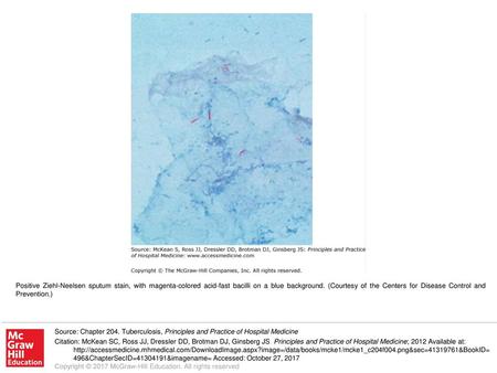 Positive Ziehl-Neelsen sputum stain, with magenta-colored acid-fast bacilli on a blue background. (Courtesy of the Centers for Disease Control and Prevention.)