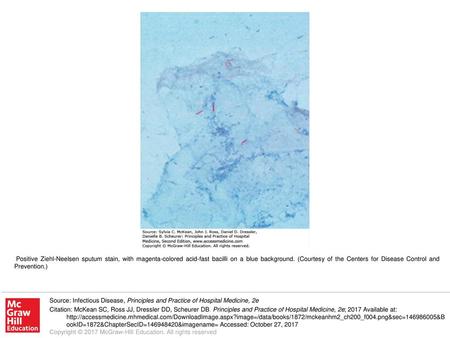 Positive Ziehl-Neelsen sputum stain, with magenta-colored acid-fast bacilli on a blue background. (Courtesy of the Centers for Disease Control and Prevention.)