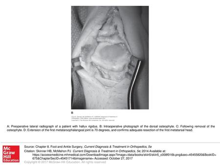 A: Preoperative lateral radiograph of a patient with hallux rigidus