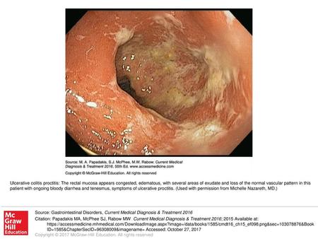 Ulcerative colitis proctitis: The rectal mucosa appears congested, edematous, with several areas of exudate and loss of the normal vascular pattern in.