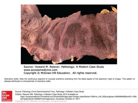 Ulcerative colitis. Note the continuous segment of mucosal erythema extending from the distal aspect of the specimen (right of image). This pattern of.