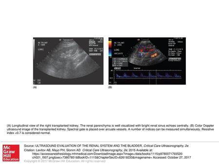 (A) Longitudinal view of the right transplanted kidney