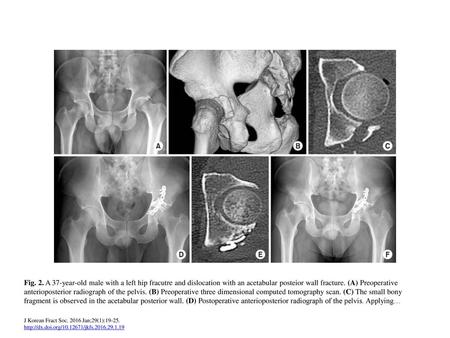 Fig. 2. A 37-year-old male with a left hip fracutre and dislocation with an acetabular posteior wall fracture. (A) Preoperative anterioposterior radiograph.