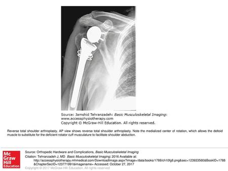 Reverse total shoulder arthroplasty