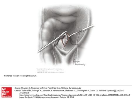 Peritoneal incision overlying the sacrum.