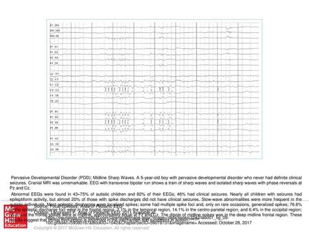 Abnormal EEGs were found in 43–75% of autistic children and 82% of their EEGs; 46% had clinical seizures. Nearly all children with seizures had epileptiform.