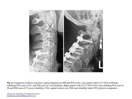 Fig. 5. Comparison of effects of positive sagittal alignment on NDI and PCS scores. Left, patient with C2-C7 SVA of 20.9mm exhibiting PCS score of 55.1.