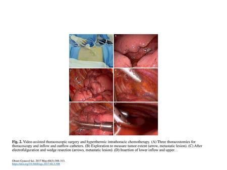 Fig. 2. Video-assisted thoracoscopic surgery and hyperthermic intrathoracic chemotherapy. (A) Three thoracostomies for thoracoscopy and inflow and outflow.