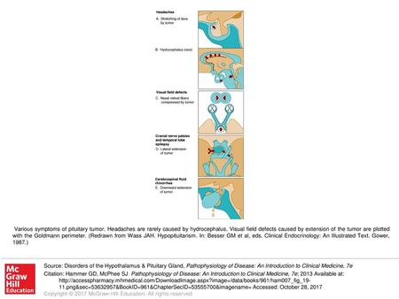 Various symptoms of pituitary tumor