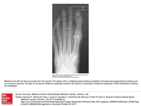 Morton’s foot with the first ray shorter than the second