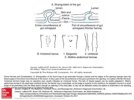 Some Hernias and Complications. A