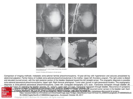 Comparison of imaging methods: metastatic extra-adrenal familial pheochromocytoma. 10-year-old boy with hypertension and seizures precipitated by abdominal.