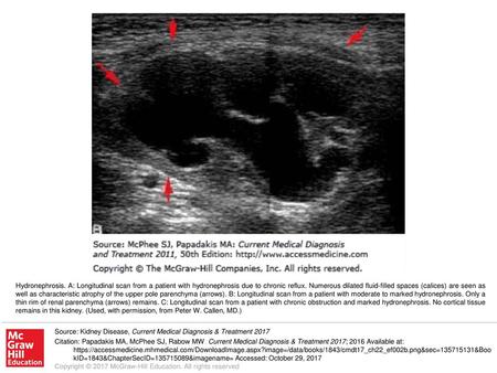 Hydronephrosis. A: Longitudinal scan from a patient with hydronephrosis due to chronic reflux. Numerous dilated fluid-filled spaces (calices) are seen.