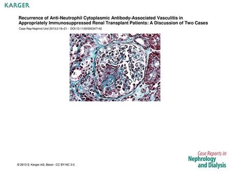 Recurrence of Anti-Neutrophil Cytoplasmic Antibody-Associated Vasculitis in Appropriately Immunosuppressed Renal Transplant Patients: A Discussion of Two.