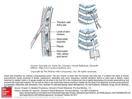 Chest tube procedure for making a subcutaneous tunnel