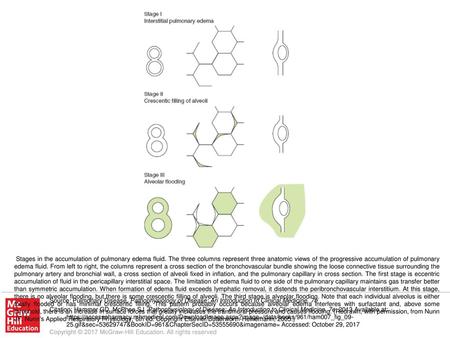 Stages in the accumulation of pulmonary edema fluid