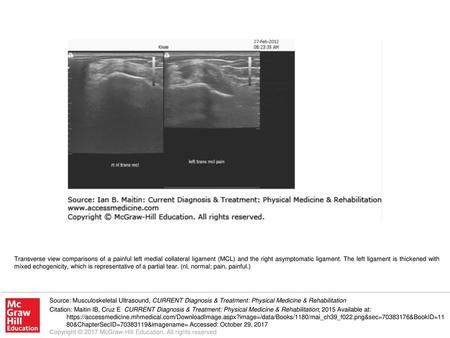 Transverse view comparisons of a painful left medial collateral ligament (MCL) and the right asymptomatic ligament. The left ligament is thickened with.