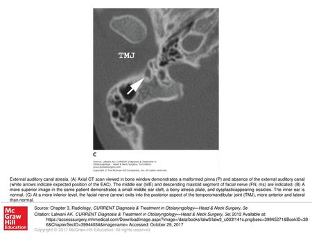 External auditory canal atresia