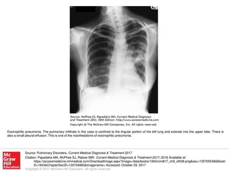 Eosinophilic pneumonia