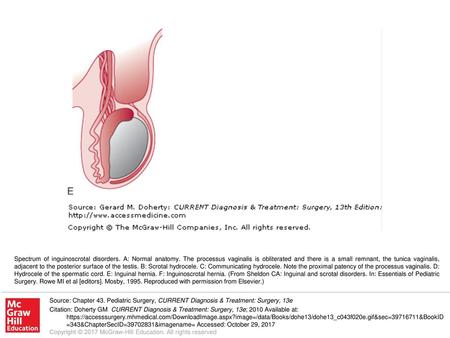 Spectrum of inguinoscrotal disorders. A: Normal anatomy