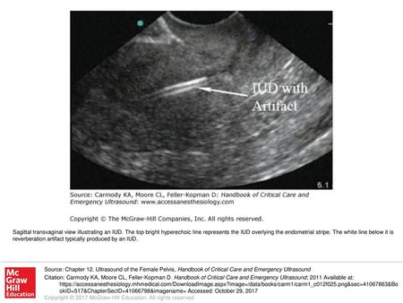 Sagittal transvaginal view illustrating an IUD